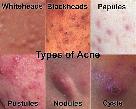 Personal account of severe adult acne, showing inflamed, cystic breakouts and post-acne scarring.