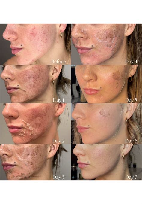 Split image showing before and after results of a chemical peel, illustrating improved skin texture, reduced acne scars, and brighter complexion.