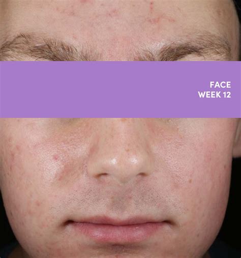 Infographic showing the timeline of acne lesion reduction with AKLIEF Cream, highlighting results at 2 weeks.