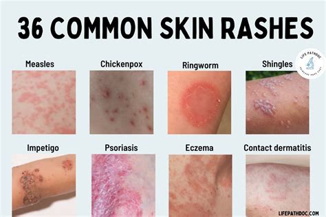 Illustration depicting common skin reactions like redness, dryness, and peeling associated with topical retinoid use.