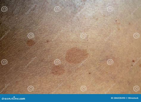 Illustration of skin with multiple discolored patches characteristic of tinea versicolor