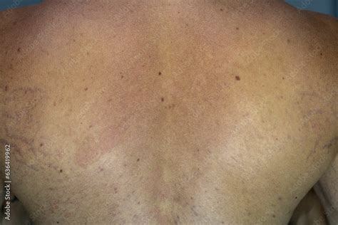 Close-up image showing scaly, discolored patches of skin on the back or chest