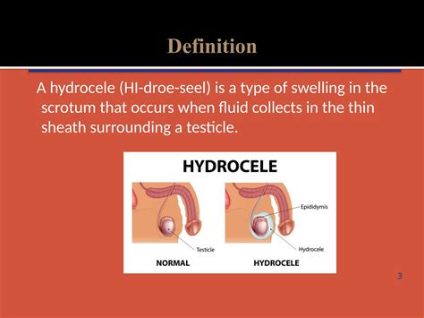 Medical illustration of a hydrocele and its fluid accumulation.