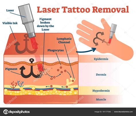 Diagram illustrating how laser tattoo removal breaks down pigment particles