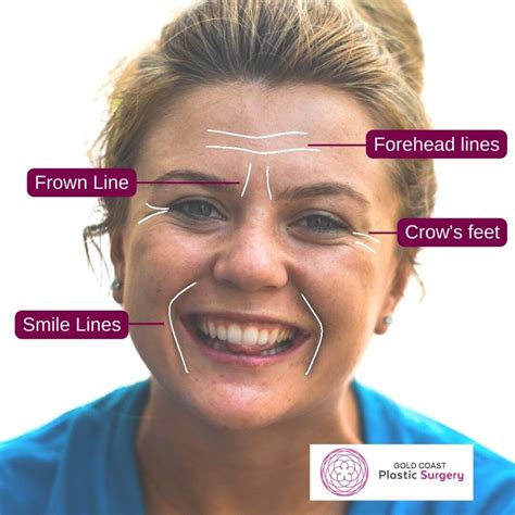 An illustration showing the different types of forehead wrinkles, including horizontal lines, frown lines (11s), and crow's feet.