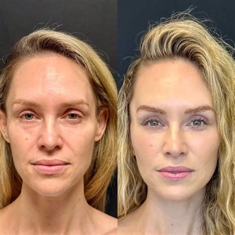 A before and after photo collage showing the results of a brow lift procedure.
