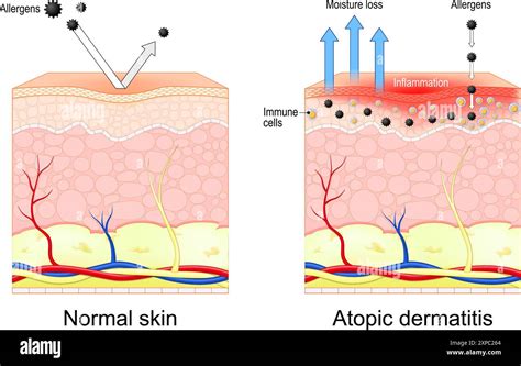 Close-up illustration of skin affected by eczema, showing dry and inflamed patches