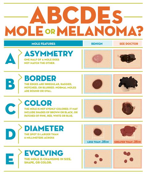 Infographic illustrating the ABCDEs of melanoma detection for moles