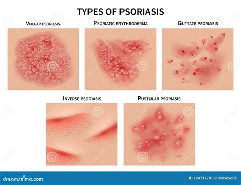 Illustration showing different types of psoriasis lesions on the skin and nails.