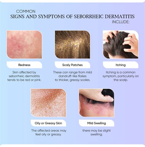 Chart comparing the effectiveness of various ingredients in managing seborrheic dermatitis.