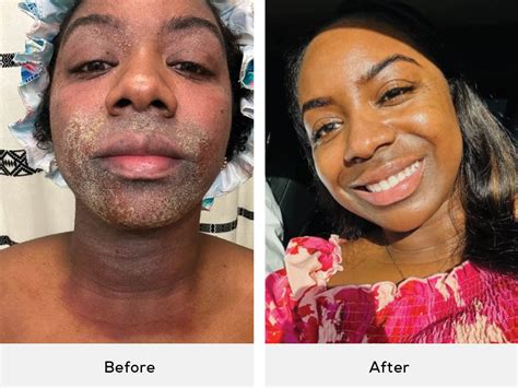 Collage of customer photos showing before-and-after results of using Dermazen products.