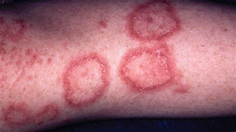 Close-up image of a discoid lupus rash with distinct, scaly patches.