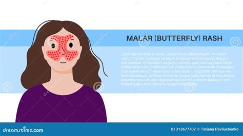 Illustration of a malar (butterfly) rash on a person's face.