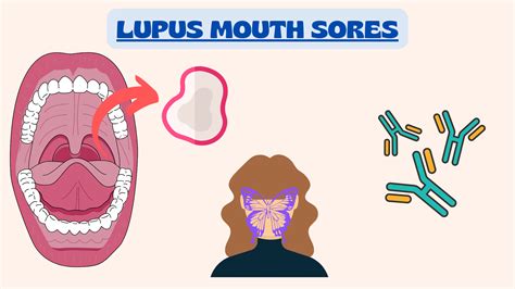 Collage of various non-specific lupus skin manifestations, including mouth sores, hives, and livedo reticularis.
