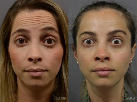 Before and after images of Botox and Juvéderm filler treatments