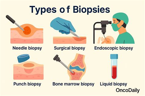 Infographic detailing different types of skin biopsies and their purposes