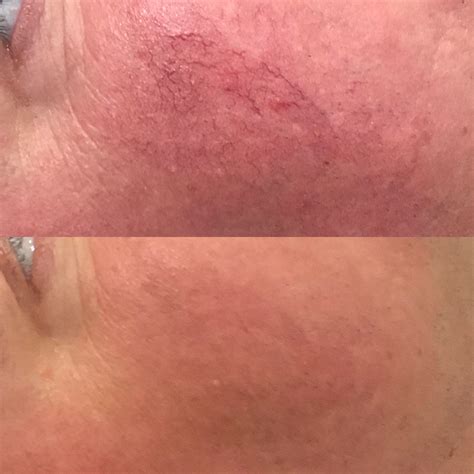 Close-up image of skin before and after Isolaz treatment, showing reduced redness and clearer pores.
