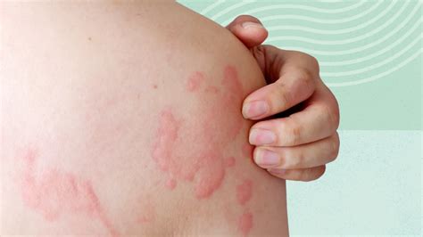 Illustration of various urgent skin conditions, such as a spreading rash or a changing mole.
