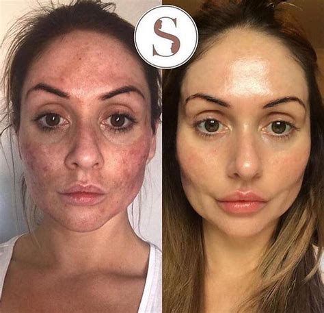 A before and after photo collage of a person's face showing dramatic improvement in skin texture and tone after a chemical peel.