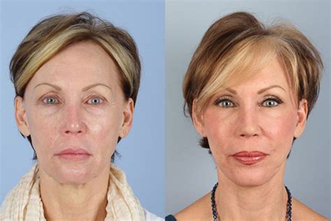 Collage of before and after photos showcasing Botox and filler results