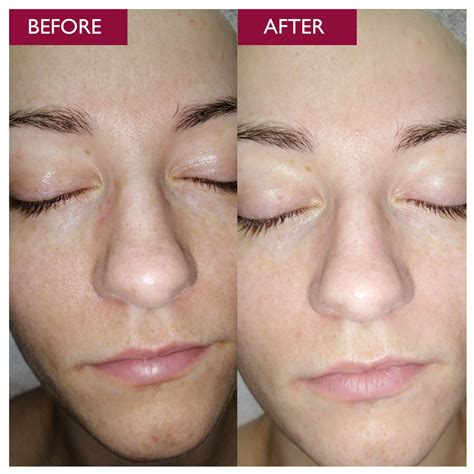 Split image showing before and after results of glycolic acid on fine lines and dark spots