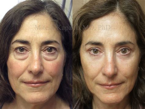 Image of a patient looking refreshed after eyelid surgery