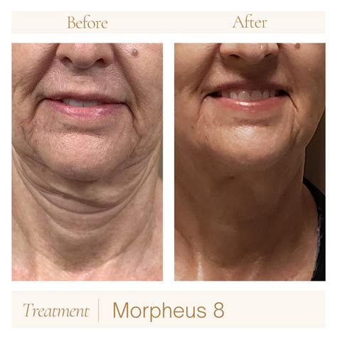 Before and after images showing skin tightening results from Morpheus8 treatment