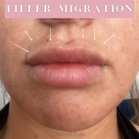 diagram illustrating normal lip filler placement versus migrated lip filler above the lip line and in other surrounding areas