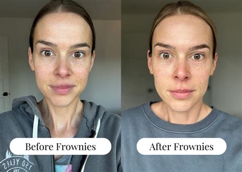 Illustration comparing Frownies patches to Botox injections as anti-aging alternatives.