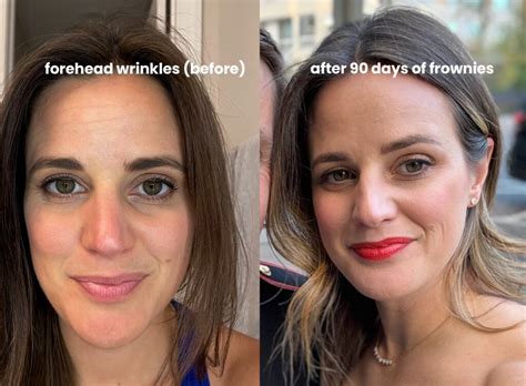 Before and after photos demonstrating the effect of Frownies on forehead wrinkles.