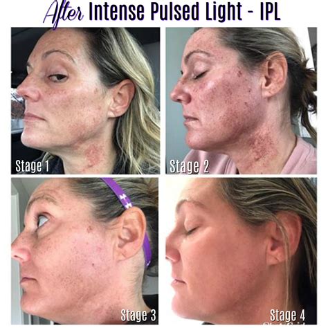 Close-up of skin after IPL treatment showing slight redness, with text overlay indicating