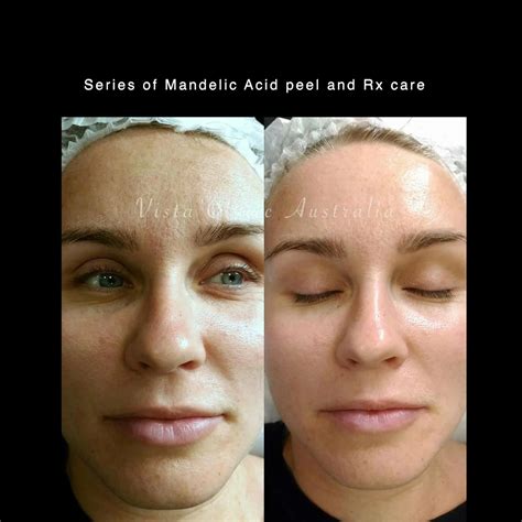 Aesthetician applying a mandelic acid peel to a client's face.