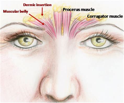 Illustration showing the corrugator and procerus muscles between the eyebrows and how they contract to form 11 lines.