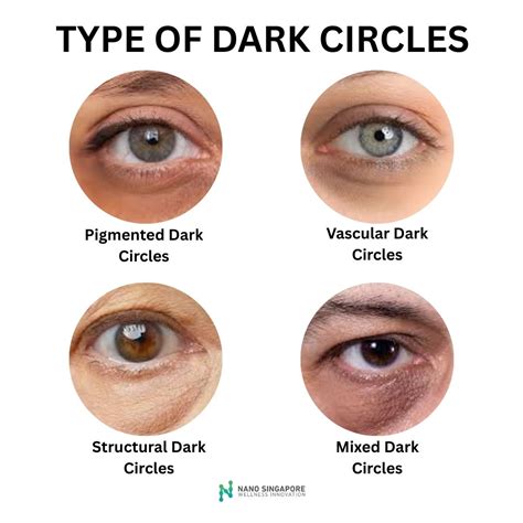 Infographic illustrating the different types of dark circles (vascular, pigmented, indented).