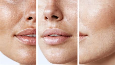 Close-up image of skin pores before and after exfoliation.