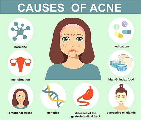 Infographic illustrating the causes and triggers of cystic acne, including hormones, diet, stress, and genetics.