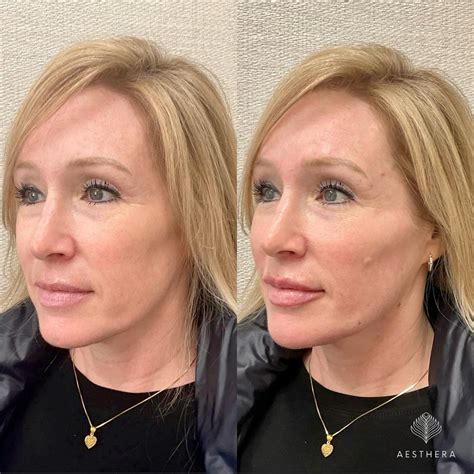 Before and after images of a patient treated with dermal fillers for wrinkles.
