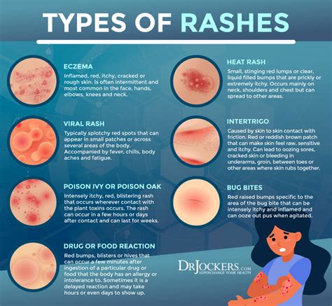 Infographic showing various types of skin rashes and their common locations on the body.
