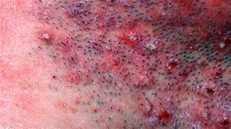Close-up of folliculitis bumps around hair follicles.