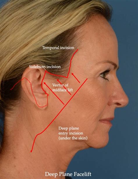 Diagram illustrating the areas targeted by a facelift procedure, focusing on the lower face, jawline, and neck.