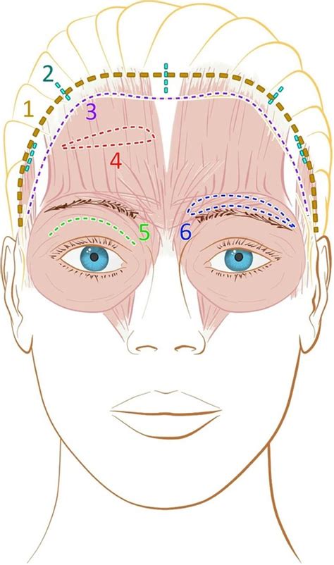 Illustration showing the areas affected by a brow lift, including the forehead, eyebrows, and upper eyelids.