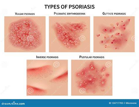 An infographic illustrating the different stages and types of psoriasis.