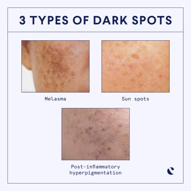Illustration showing different types of dark spots on a face: sunspots, PIH, melasma