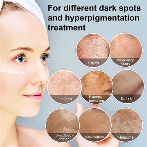 Infographic detailing the causes and appearance of different types of dark spots
