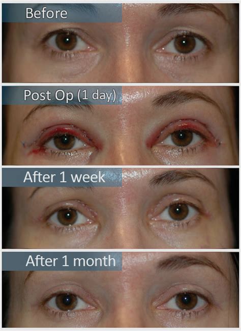 Diagram illustrating the typical timeline of swelling and bruising after eyelid surgery, showing peak at 48-72 hours and gradual reduction over weeks.
