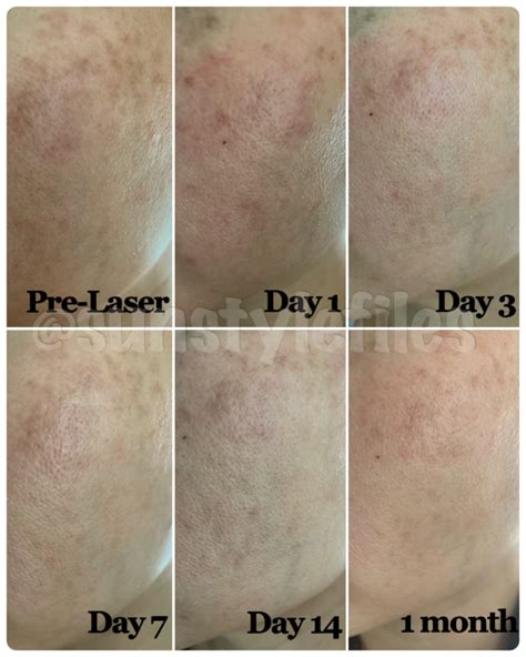 Timeline graphic showing expected skin changes day by day after Pico Laser treatment.