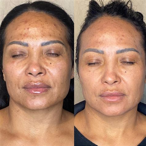 Split image showing before and after microdermabrasion results, highlighting improved skin texture and reduced hyperpigmentation.