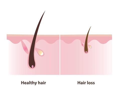 Illustration of a healthy hair follicle and scalp