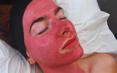Close-up image showing skin redness after microneedling treatment.