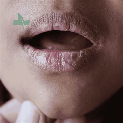 Illustration of a person experiencing dry skin and chapped lips due to medication